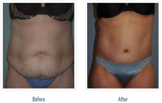 Tummy Tuck Before & After Picture Regina Rosenthal MD FACS