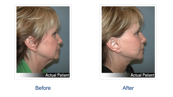 Necklift | Before and after