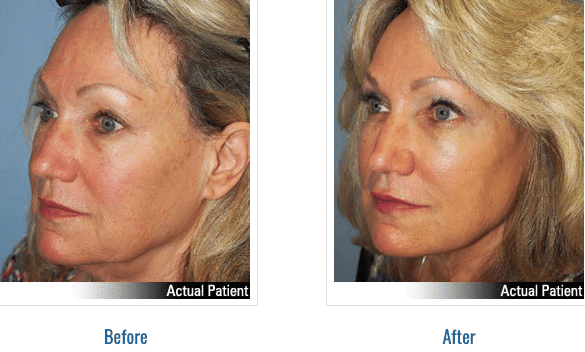 A before and after image set of a woman that received Kybella injections