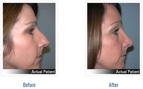 Before and after pictures of Nose Surgery