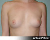 Breast Augmentation Patient