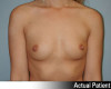 Breast Augmentation Patient