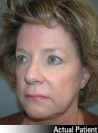 Facelift Patient