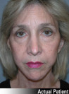 Facelift Patient