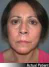 Facelift Patient