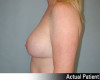 Patient # 43725 After Photo Thumbnail # 6