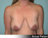 Breast Lift and Augmentation Patient