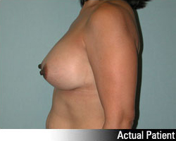 Patient # 84188 After Photo # 6