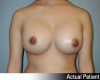 Breast Augmentation Patient