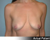 Breast Augmentation Patient