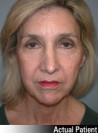 Facelift Patient