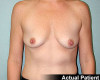 Breast Augmentation Patient