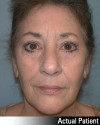 Eyelid Lift - Blepharoplasty Patient