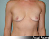 Breast Augmentation Patient