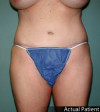 Tummy Tuck Patient