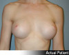 Breast Augmentation Patient