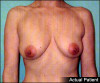 Breast Lift and Augmentation Patient