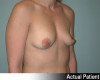 Patient # 83421 Before Photo Thumbnail # 3