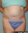 Tummy Tuck Patient