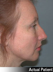 Patient # 21025 Before Photo # 3