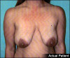 Breast Lift and Augmentation Patient