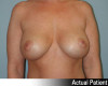 Breast Augmentation Patient