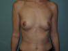 Breast Augmentation Patient