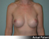 Breast Augmentation Patient