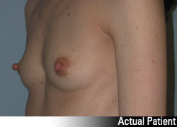 Patient # 27466 Before Photo # 3