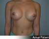 Breast Augmentation Patient