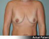 Breast Augmentation Patient