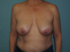 Breast Reduction Patient