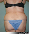 Liposuction Patient