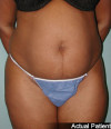 Tummy Tuck Patient