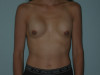 Breast Implant Exchange Patient