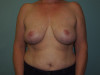 Breast Reduction Patient