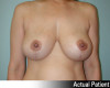 Breast Reduction Patient