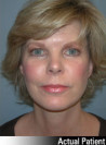 Facelift Patient