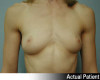 Breast Augmentation Patient