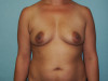 Breast Augmentation Patient