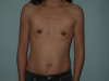 Breast Augmentation Patient