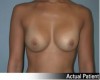 Breast Augmentation Patient