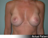 Breast Augmentation Patient