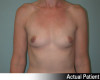 Breast Augmentation Patient