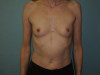 Breast Augmentation Patient