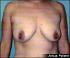 Breast Lift and Augmentation Patient