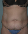 Tummy Tuck Patient