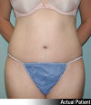 Tummy Tuck Patient