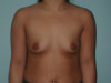 Breast Augmentation Patient