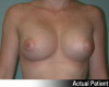 Breast Augmentation Patient